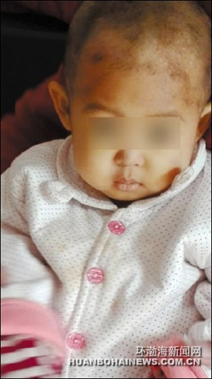 ������ħϮ��2��Ůͯ ��ĸ��Ѫ�������ȾȺ��ӡ�